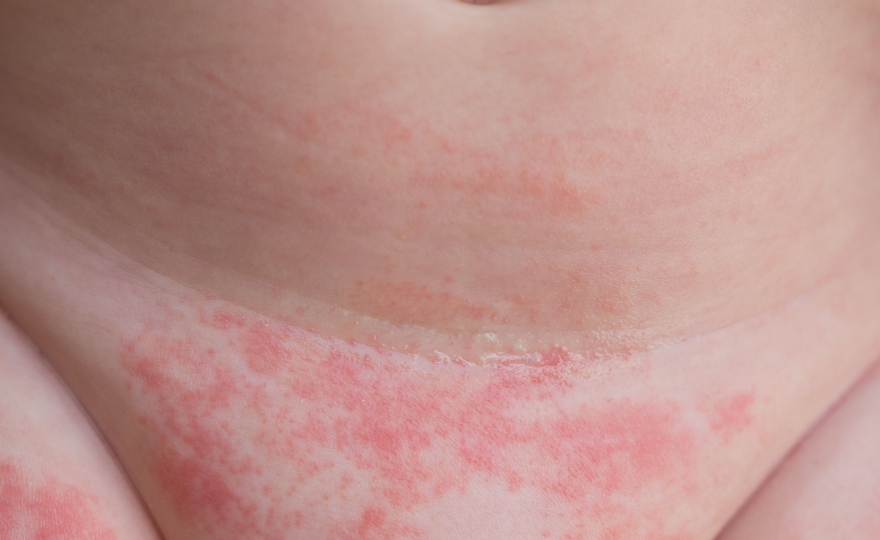 Dermatitis del Pañal